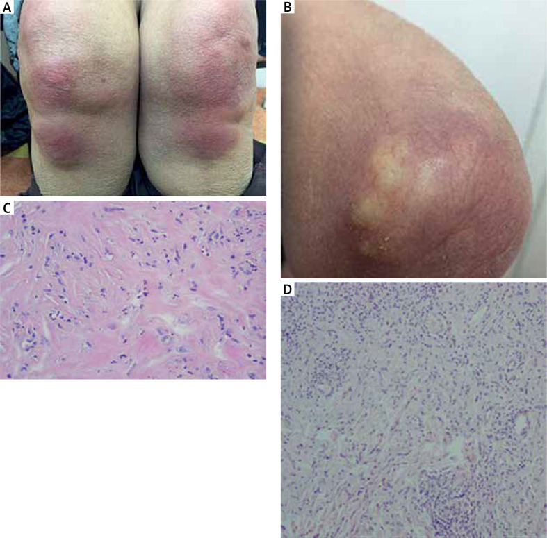 Challenging diagnosis of the spectrum of reactive granulomatous dermatitis: two case reports and literature review.