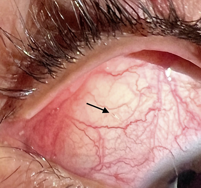 Ophthalmomyiasis Externa: A Case Report in a Tertiary Care Center in Riyadh, Saudi Arabia.