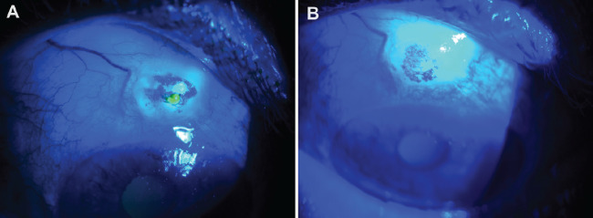 Conjunctival Collagen Cross-Linking for the Treatment of Leaking Avascular Cystic Bleb.