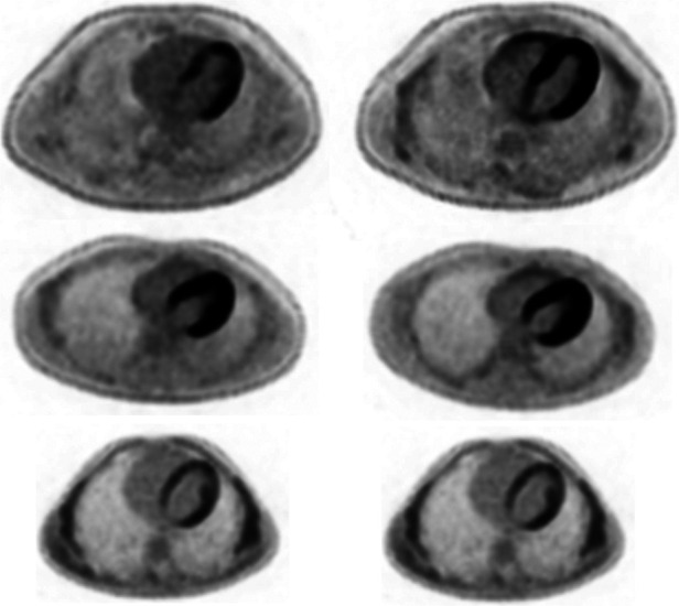 A novel method in myocardial injury risk stratification using intravenous fat emulsion as sole rapid preparation for unfasted patients to suppress myocardial 18F-fluorodeoxyglucose uptake for optimal cardiac PET imaging: a proof-of-concept randomized-crossover trial.