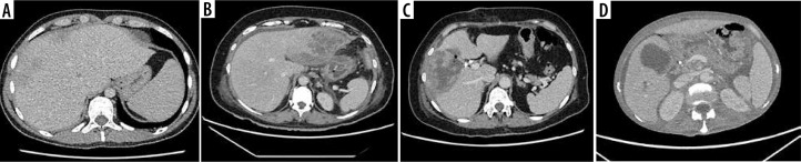 Comparative efficacy of contrast-enhanced ultrasound versus B-mode ultrasound in the diagnosis and monitoring of hepatic abscesses.