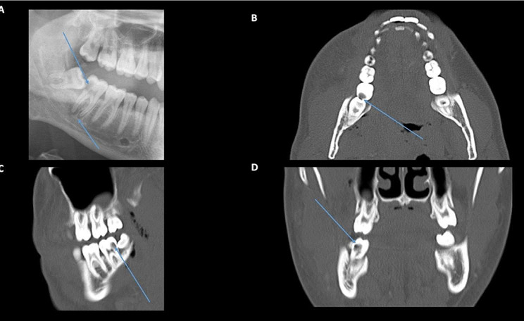 Clinical and radiological characteristics of odontogenic orbital cellulitis.