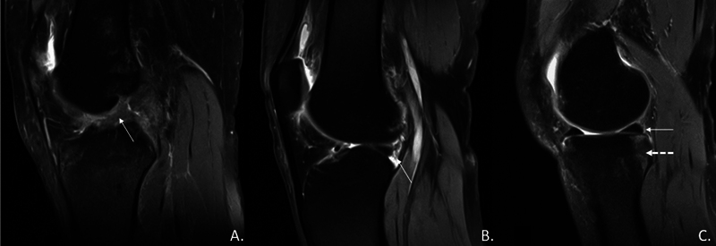 Is Trochlear Dysplasia Associated with a High Prevalence of Repaired Anterior Medial Portal Lesions in Anterior Cruciate Ligament-Deficient Knees?