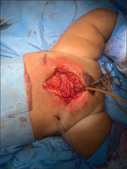 Rectus Muscle Flap-augmented Closures in Wide-gap Exstrophy Bladder.