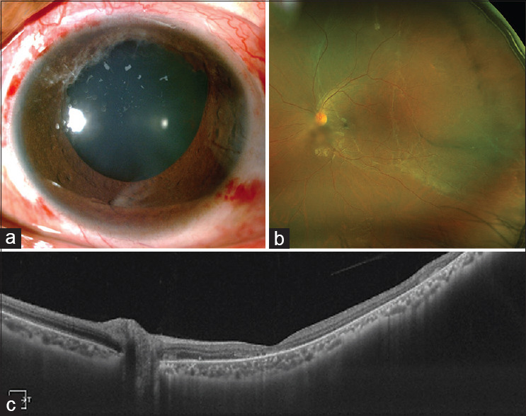 Anterior segment ischemia following scleral buckle surgery: The forgotten enemy.