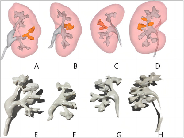 Integrating 3D technology with the Sampaio classification for enhanced percutaneous nephrolithotomy in complex renal calculi treatment.