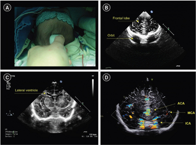 Intraoperative transfontanelle ultrasonography for pediatric patients.