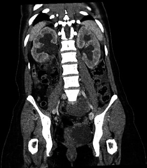 Large Endometrioma That Triggered a Hypertensive Emergency: A Case Report.