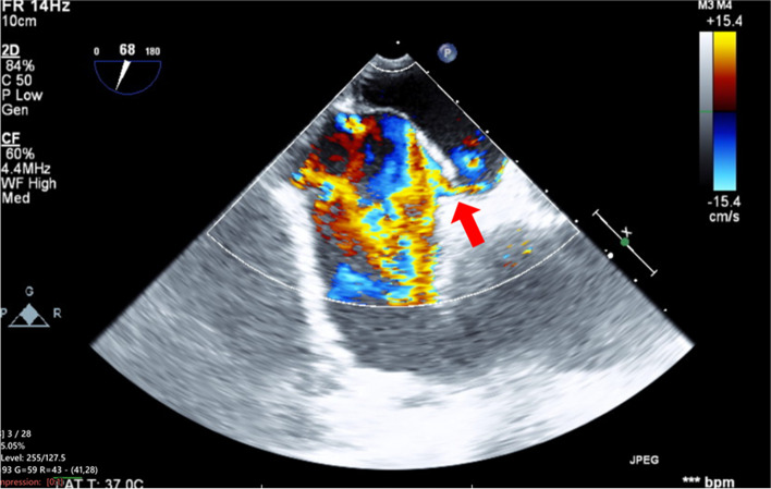 Dynamic shunt flow alterations through patent foramen ovale during off-pump coronary artery bypass grafting induced by airway pressure changes: a case report.
