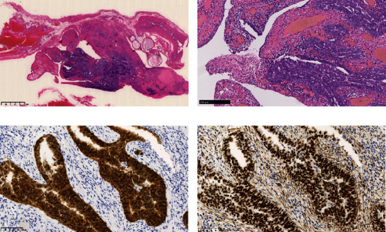 A Case of Carcinosarcoma of the Peritoneum With Serous Tubal Intraepithelial Carcinoma.