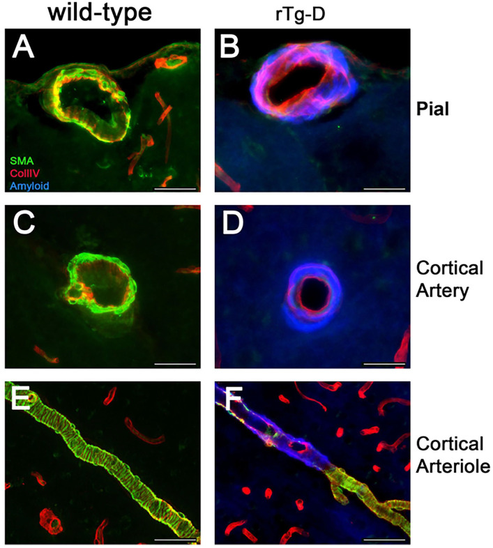 Cerebral Proteomic Changes in the rTg-D Rat Model of Cerebral Amyloid Angiopathy Type-2 With Cortical Microhemorrhages and Cognitive Impairments.