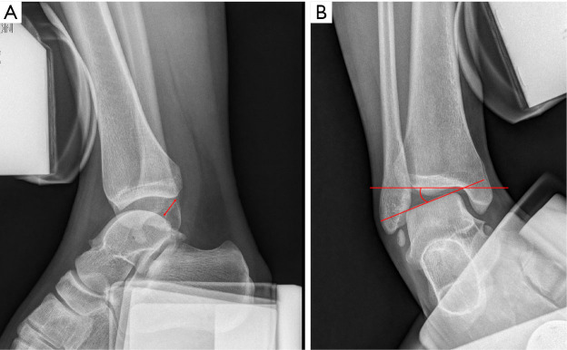 Diagnostic strategies for chronic lateral ankle instability: a narrative review.