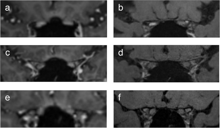 Accuracy of Diagnosing Optic Neuritis Using DANTE T1-SPACE Imaging.