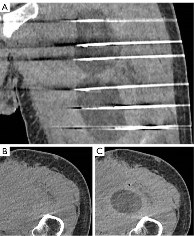Abscopal effect induced by cryoablation in a 55-year-old patient with metastatic dedifferentiated liposarcoma: a case report.