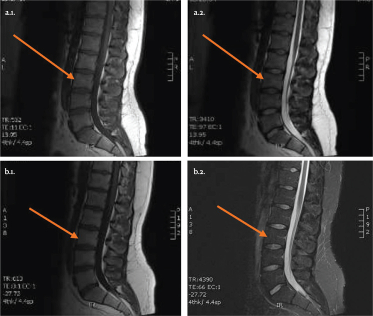 EXPLORING THE FEASIBILITY OF PLATELET-RICH PLASMA INJECTIONS FOR INTERVERTEBRAL DISCOPATHY: A PILOT STUDY.