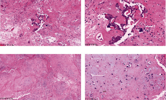 A Case of Carcinosarcoma of the Peritoneum With Serous Tubal Intraepithelial Carcinoma.
