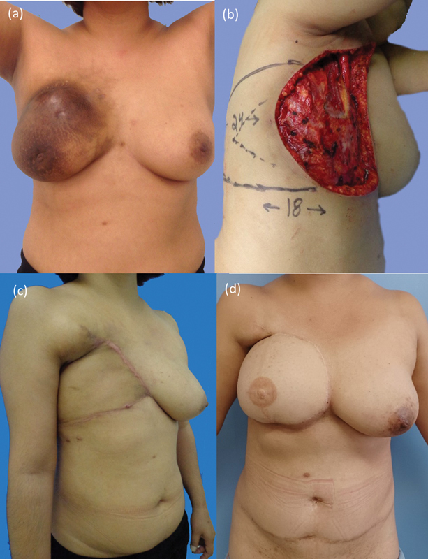 Postmastectomy Late Breast Reconstruction with Transverse Rectus Abdominis Flap after Primary Closure with Latissimus Dorsi.