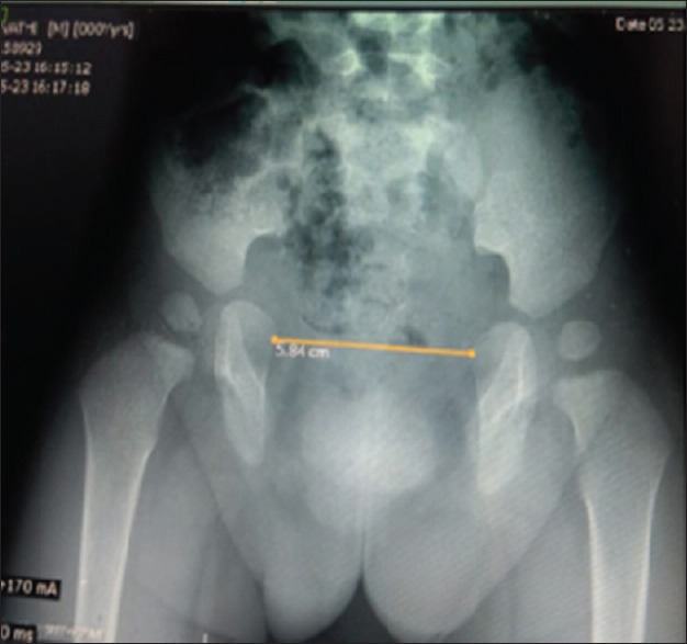 Rectus Muscle Flap-augmented Closures in Wide-gap Exstrophy Bladder.