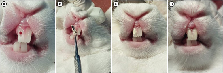Histological evaluation of pulp response to alendronate and Biodentine as pulp capping agents: an animal study.