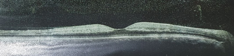 A Successful Case of Intervention for Traumatic Central Retinal Artery Occlusion.