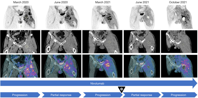 Abscopal effect induced by cryoablation in a 55-year-old patient with metastatic dedifferentiated liposarcoma: a case report.