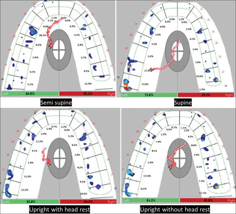 An analysis of three dimensional changes to comprehensively evaluate the occlusion time, disclusion time, point of first contact and force distribution at various head positions using Tekscan III: An in vivo study.