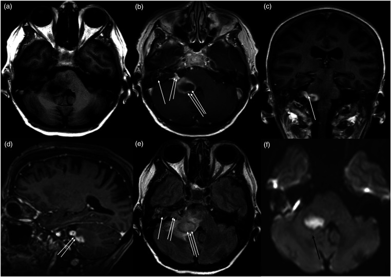 Cranial nerves bridging the middle ear and cerebellum causing cerebellar peduncle abscess: A case report.