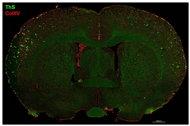 Cerebral Proteomic Changes in the rTg-D Rat Model of Cerebral Amyloid Angiopathy Type-2 With Cortical Microhemorrhages and Cognitive Impairments.
