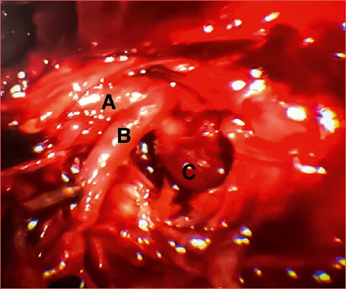 Utility of intraoperative scoring system in rhino-orbital mucormycosis as a prognostic tool.