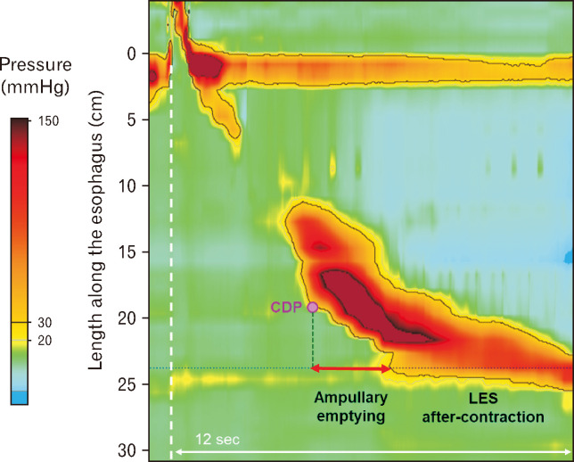 Phrenic Ampulla Emptying Dysfunction: Unveiling the Role of Lower Esophageal Sphincter After-contraction.