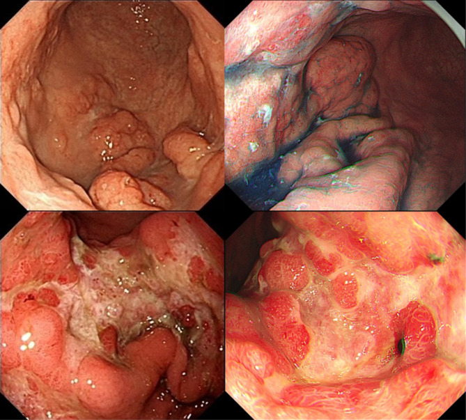 Endoscopic morphology of gastric MALT lymphoma correlate with API2/MALT1 fusion and predict treatment response after helicobacter pylori eradication.