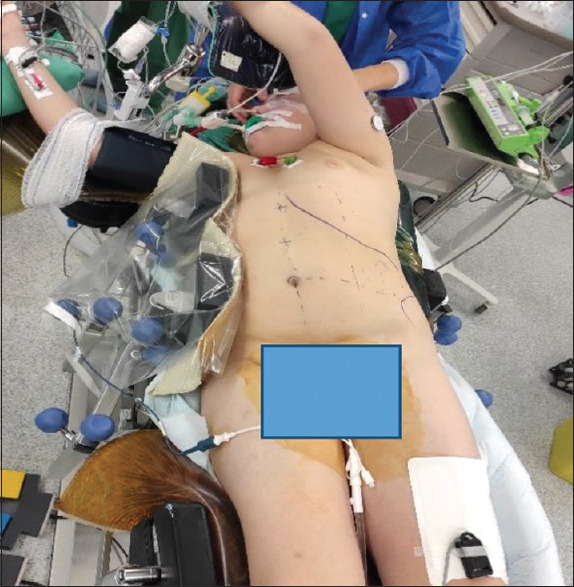Epidermoid Splenic Cyst in Children Treated by Laparoscopic Partial Splenectomy.