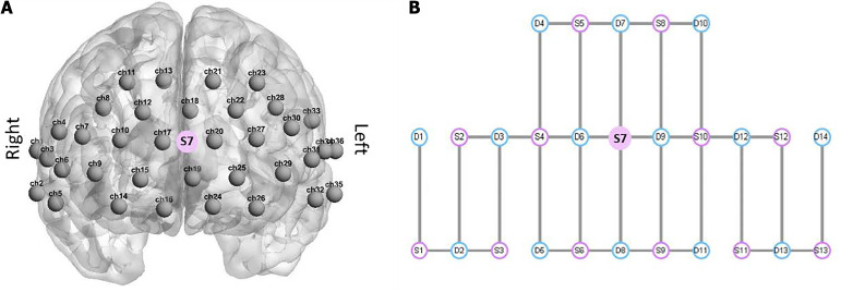 Brain networks in newborns and infants with and without sensorineural hearing loss: A functional near-infrared spectroscopy study.