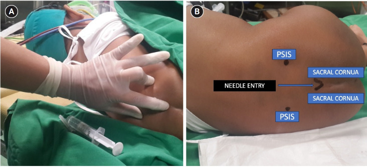 Expert's tips on regional blocks in neonates and infants.