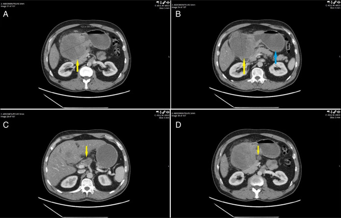 Metastatic Small Cell Carcinoma of the Stomach.