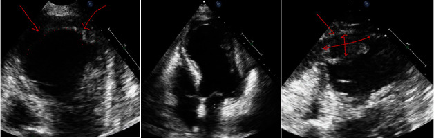 Survival and Recovery From Postmyocardial Infarction Apical Wall Rupture With a Complex Course.