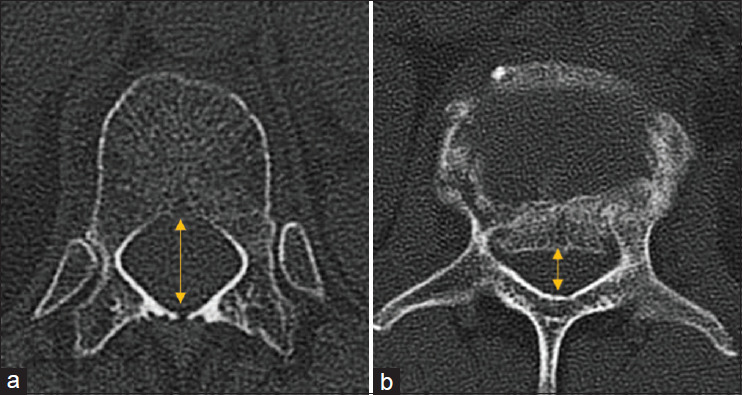 The effectiveness of posterior Schanz screw system in the anatomical restoration of thoracolumbar vertebral burst fractures: A 10-year single-institution experience.