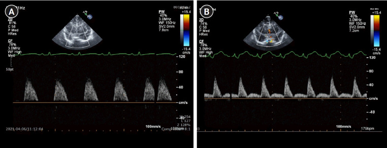Intraoperative transfontanelle ultrasonography for pediatric patients.