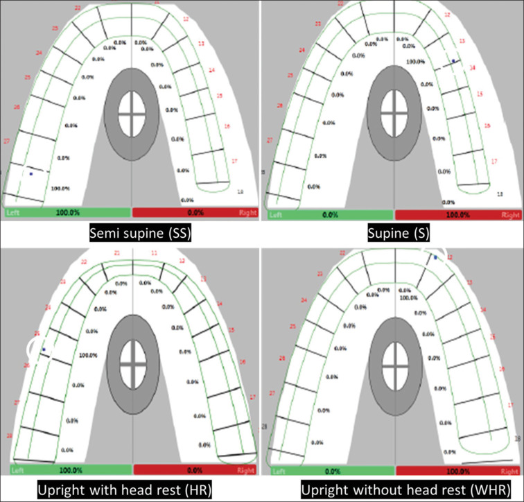An analysis of three dimensional changes to comprehensively evaluate the occlusion time, disclusion time, point of first contact and force distribution at various head positions using Tekscan III: An in vivo study.