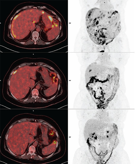 Cooccurrence of Capsular Liver Lesions Along with Peritoneal Carcinomatosis and Hematogenous Metastases in Ovarian Cancer Patients on Consecutive <sup>18</sup>F-FDG PET/CT Studies.