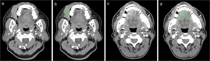 Predicting response to immunotherapy in oral squamous cell carcinoma via a CT-based radiomics model.