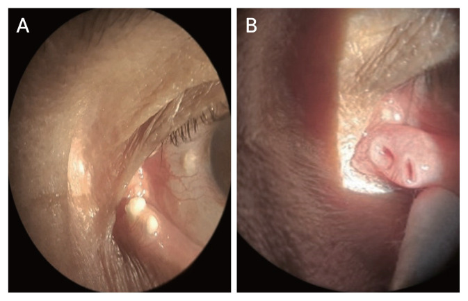 "Pig Snout" Canaliculus: A Rare Case of Actinomyces Canaliculitis in Double Puncta.