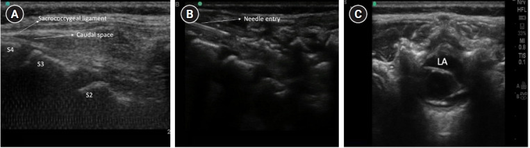Expert's tips on regional blocks in neonates and infants.