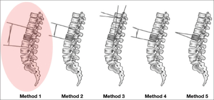 The effectiveness of posterior Schanz screw system in the anatomical restoration of thoracolumbar vertebral burst fractures: A 10-year single-institution experience.