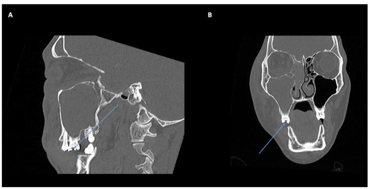 Clinical and radiological characteristics of odontogenic orbital cellulitis.