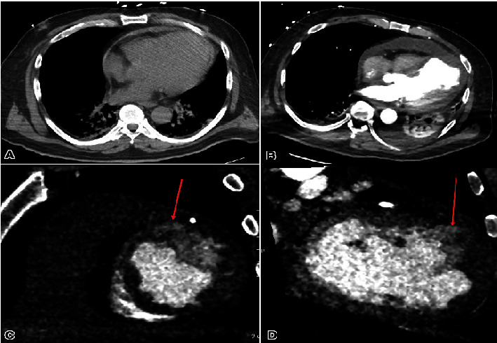 Survival and Recovery From Postmyocardial Infarction Apical Wall Rupture With a Complex Course.