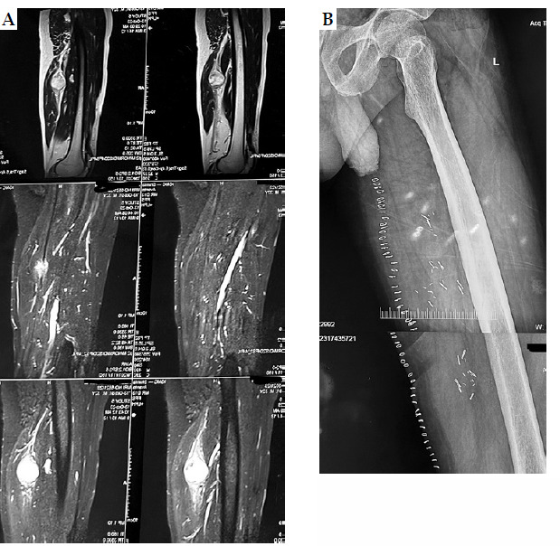 In-depth feasibility study on conservative surgery, perioperative high-dose-rate brachytherapy, and external beam radiation therapy, with a focus on interstitial brachytherapy for soft tissue sarcomas: Insights from a single-institute experience.