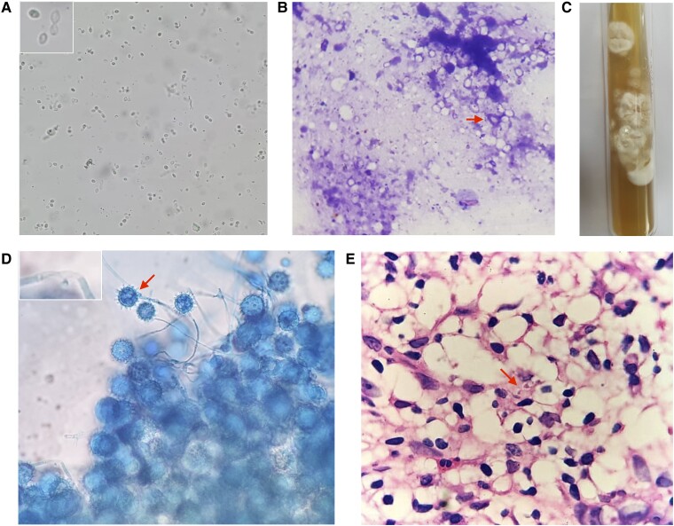 Hypercalcemia Due to Progressive Disseminated Histoplasmosis.
