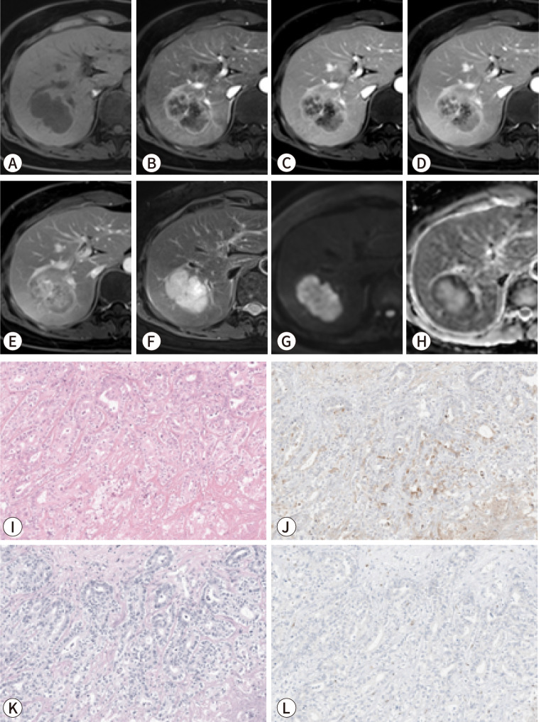 Imaging findings of intrahepatic cholangiocarcinoma for prognosis prediction and treatment decision-making: a narrative review.