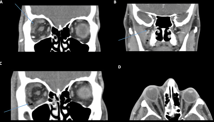 Clinical and radiological characteristics of odontogenic orbital cellulitis.